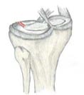 Lateral Cartilage Tear